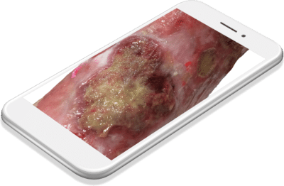 telephone plaie transparent 400x262