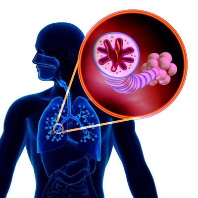 asthma chronic inflammatory disease